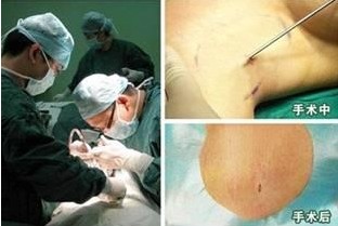 腋臭微创手术多少钱 团队.jpg