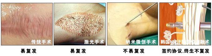 腋臭比较好的治疗方法 手术效果对比.jpg