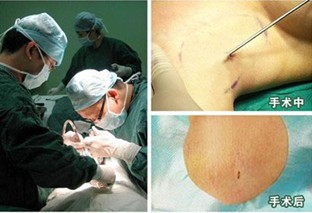 改良小切口汗腺清除术改良小切口汗腺清除术手术过程及效果展现 手术过程.JPG